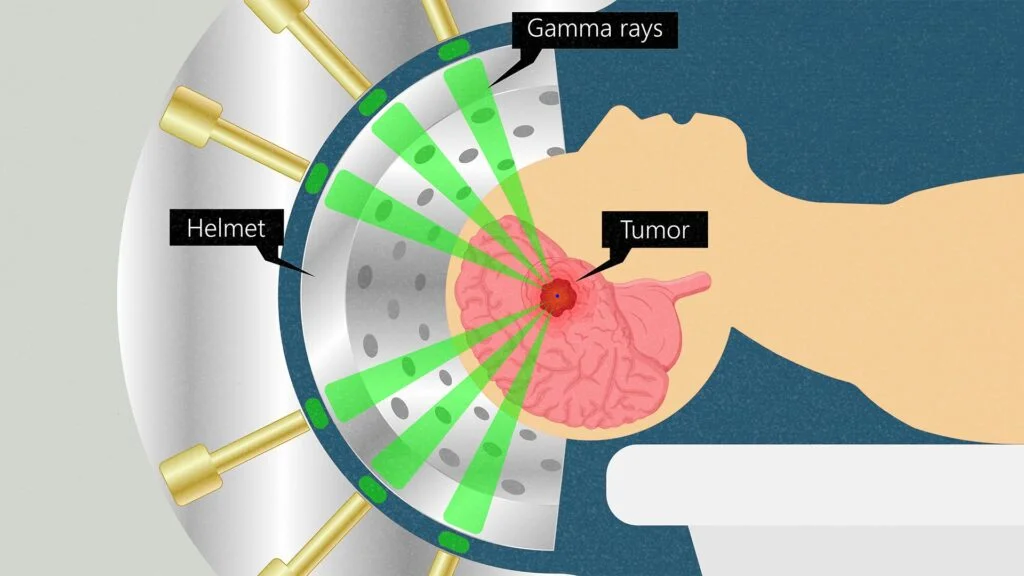 radiotherapy